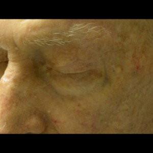 After-Eyelid Reconstruction