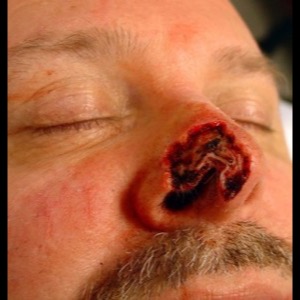 Before-Nose Reconstruction