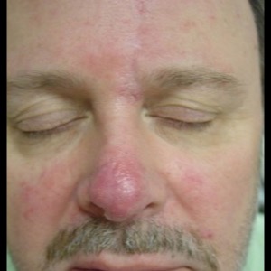 After-Nose Reconstruction
