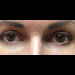 After-Periorbital Filler