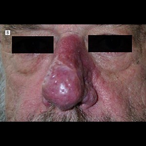 After-Rhinophyma