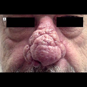 Before-Rhinophyma