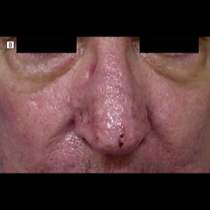 After-Rhinophyma