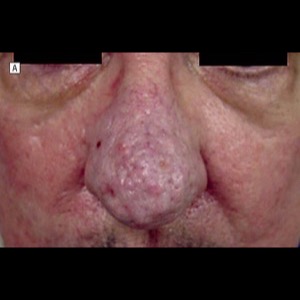 Before-Rhinophyma